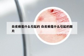 白皮癣是什么引起的 白皮癣是什么引起的图片