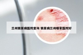 兰州银屑病医院查询 银屑病兰州哪家医院好