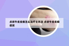 点状牛皮皮癣怎么治疗土方法 点状牛皮皮癣症状