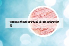 沈阳银屑病医院哪个权威 沈阳银屑病专科医院