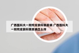 广西医科大一附院皮肤科银屑病 广西医科大一附院皮肤科银屑病怎么样