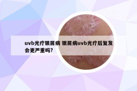 uvb光疗银屑病 银屑病uvb光疗后复发会更严重吗?
