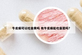 牛皮癣可以吃韭黄吗 有牛皮癣能吃韭菜吗?