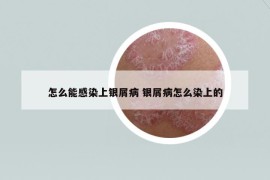 怎么能感染上银屑病 银屑病怎么染上的