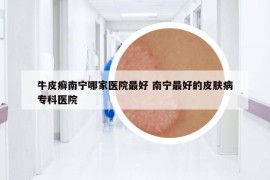 牛皮癣南宁哪家医院最好 南宁最好的皮肤病专科医院