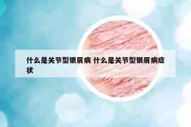 什么是关节型银屑病 什么是关节型银屑病症状