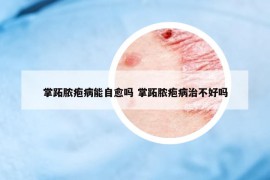 掌跖脓疱病能自愈吗 掌跖脓疱病治不好吗