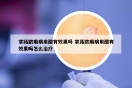 掌跖脓疱病用醋有效果吗 掌跖脓疱病用醋有效果吗怎么治疗