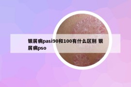 银屑病pasi90和100有什么区别 银屑病pso