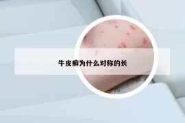 牛皮癣为什么对称的长