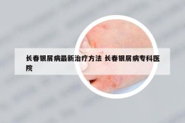 长春银屑病最新治疗方法 长春银屑病专科医院
