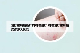 治疗银屑病最好的物理治疗 物理治疗银屑病皮疹多久见效