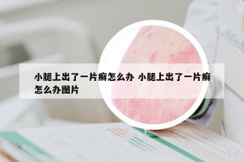 小腿上出了一片癣怎么办 小腿上出了一片癣怎么办图片