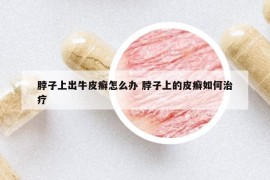 脖子上出牛皮癣怎么办 脖子上的皮癣如何治疗