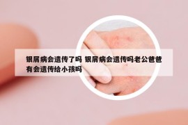 银屑病会遗传了吗 银屑病会遗传吗老公爸爸有会遗传给小孩吗