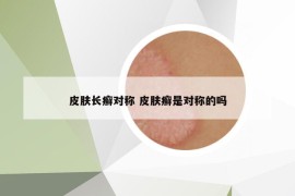 皮肤长癣对称 皮肤癣是对称的吗