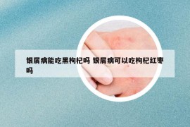 银屑病能吃黑枸杞吗 银屑病可以吃枸杞红枣吗