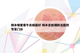 桐乡哪里看牛皮癣最好 桐乡皮肤病防治医院专家门诊