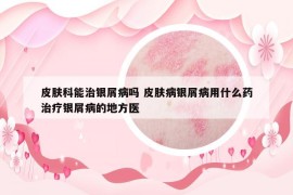 皮肤科能治银屑病吗 皮肤病银屑病用什么药治疗银屑病的地方医