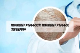 银屑病最长时间不复发 银屑病最长时间不复发的是哪种