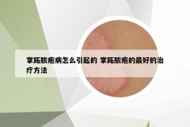 掌跖脓疱病怎么引起的 掌跖脓疱的最好的治疗方法