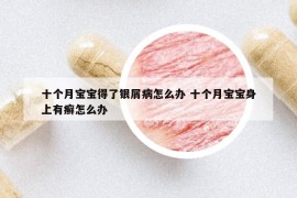 十个月宝宝得了银屑病怎么办 十个月宝宝身上有癣怎么办