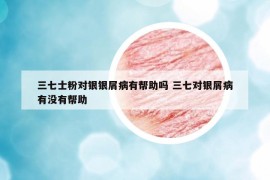 三七士粉对银银屑病有帮助吗 三七对银屑病有没有帮助