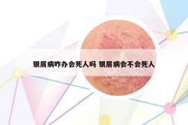 银屑病咋办会死人吗 银屑病会不会死人