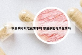 银屑病可以吃花生米吗 银屑病能吃炒花生吗