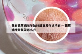 我有银屑病每年始终反复发作试问有… 银屑病经常复发怎么办