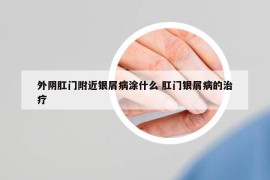 外阴肛门附近银屑病涂什么 肛门银屑病的治疗