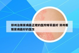 郑州治银屑病最正规的医院哪家最好 郑州看银屑病最好的医生