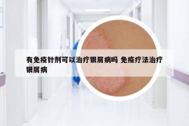 有免疫针剂可以治疗银屑病吗 免疫疗法治疗银屑病