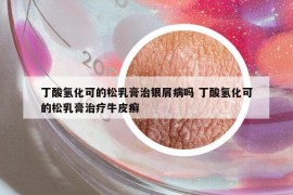 丁酸氢化可的松乳膏治银屑病吗 丁酸氢化可的松乳膏治疗牛皮癣
