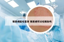 银屑病能吃蔓菁 银屑病可以吃鳗鱼吗