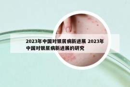 2023年中国对银屑病新进展 2023年中国对银屑病新进展的研究