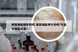 银屑病能喝牛奶吗 银屑病能喝牛奶吗?不能吃哪些水果?