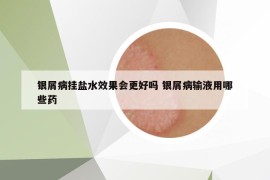 银屑病挂盐水效果会更好吗 银屑病输液用哪些药