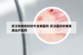 武汉有哪些好的牛皮癣医院 武汉最好的银屑病治疗医院