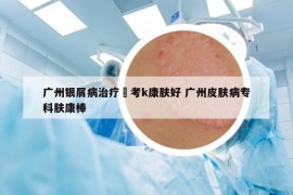 广州银屑病治疗參考k康肤好 广州皮肤病专科肤康棒