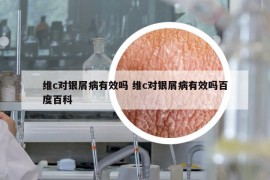 维c对银屑病有效吗 维c对银屑病有效吗百度百科