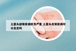 儿童头部银屑病脱发严重 儿童头皮银屑病可以自愈吗