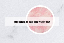 银屑病有偏方 银屑病偏方治疗方法