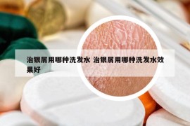 治银屑用哪种洗发水 治银屑用哪种洗发水效果好