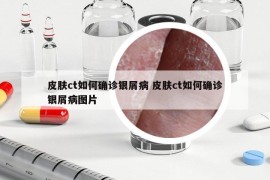 皮肤ct如何确诊银屑病 皮肤ct如何确诊银屑病图片