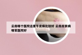 云南哪个医院这里牛皮癣比较好 云南皮肤病哪家医院好