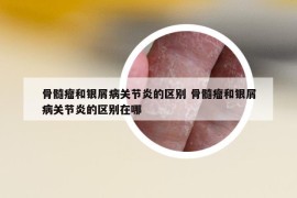 骨髓瘤和银屑病关节炎的区别 骨髓瘤和银屑病关节炎的区别在哪