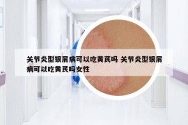 关节炎型银屑病可以吃黄芪吗 关节炎型银屑病可以吃黄芪吗女性
