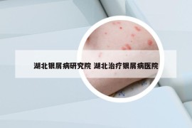 湖北银屑病研究院 湖北治疗银屑病医院