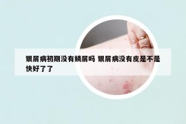 银屑病初期没有鳞屑吗 银屑病没有皮是不是快好了了